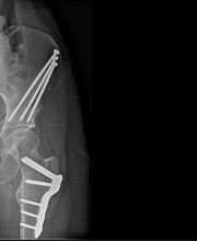 X-ray showing both periacetabular and femoral osteotomy