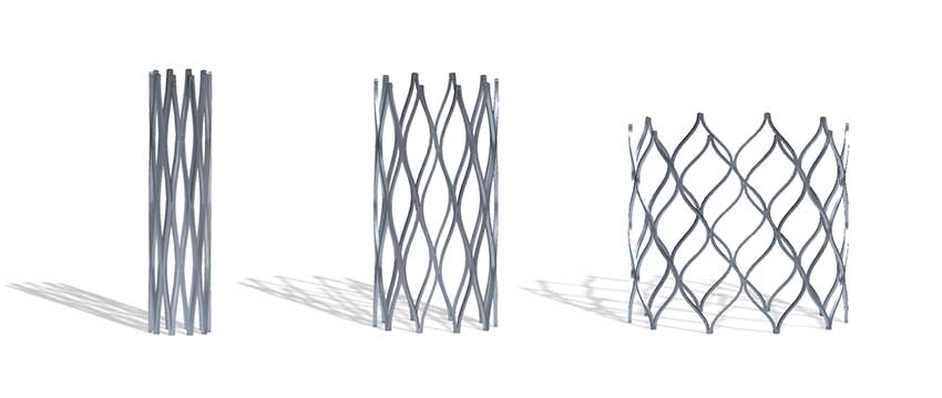 Illustration of a Renata Minima Stent. The Renata Minima Stent can be gradually expanded up to adult size over the course of the child’s lifetime.