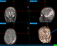 Precise image-guided surgery for epilepsy