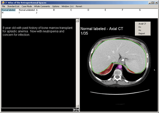 Retroperitoneal Spaces Atlas Screen Shot 2