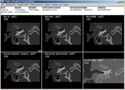 Temporal Bone Atlas Screen Shot 1